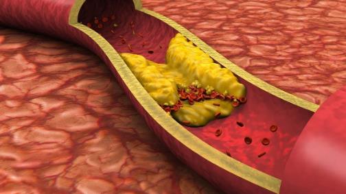 坏胆固醇和中性脂肪高 是动脉硬化的警讯