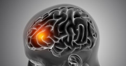 测量大脑中的铁沉积可以检测老年痴呆