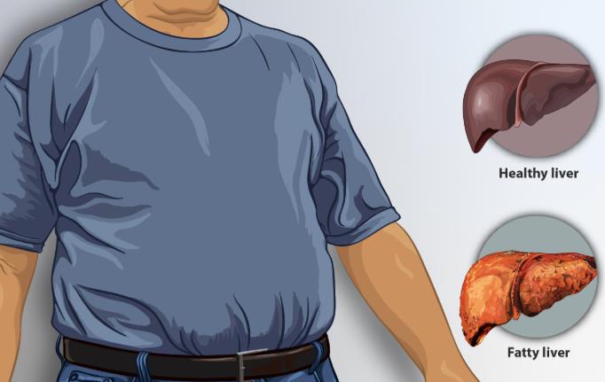 哪些生活坏习惯，是导致脂肪肝的元凶？
